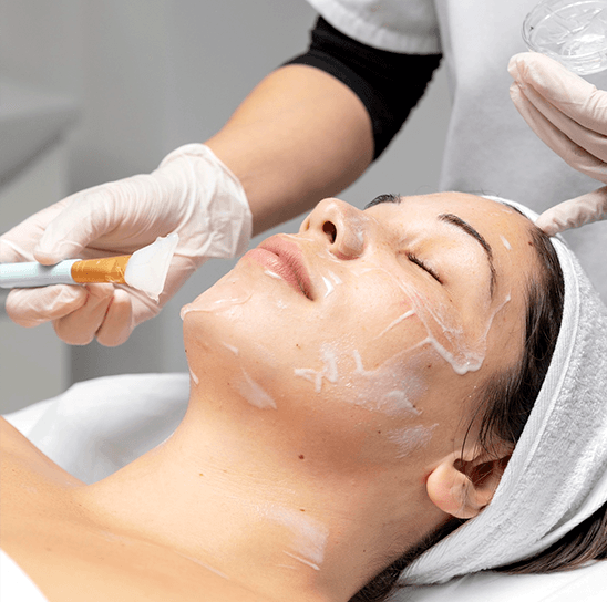 Chemical Peel