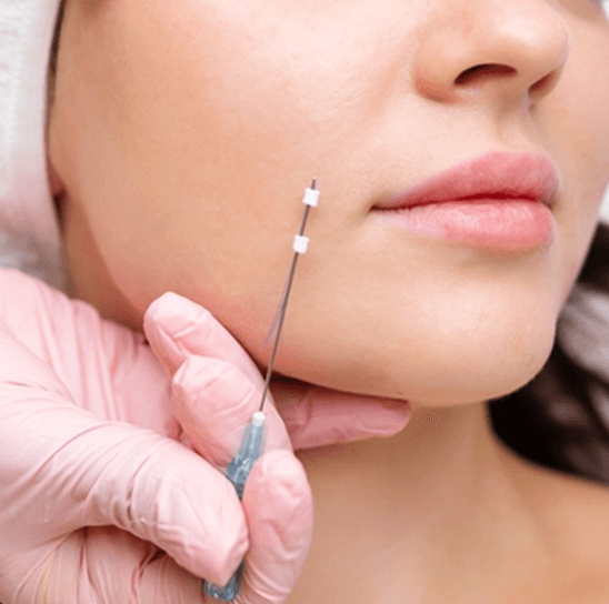 ThreadLift Treatment